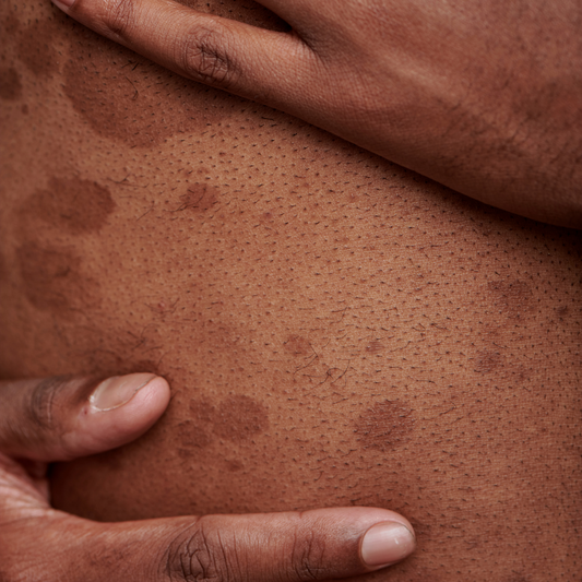 HYPERPIGMENTATION : causes, types et solutions naturelles efficaces