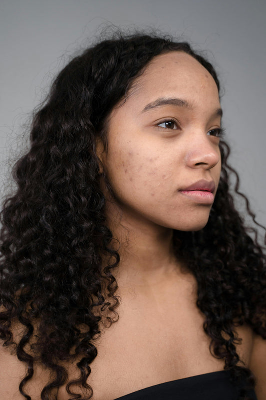 Gros plan sur le visage d'une femme aux cheveux bouclés, peau à imperfections